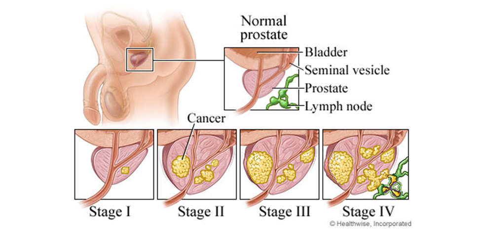 prostate 2